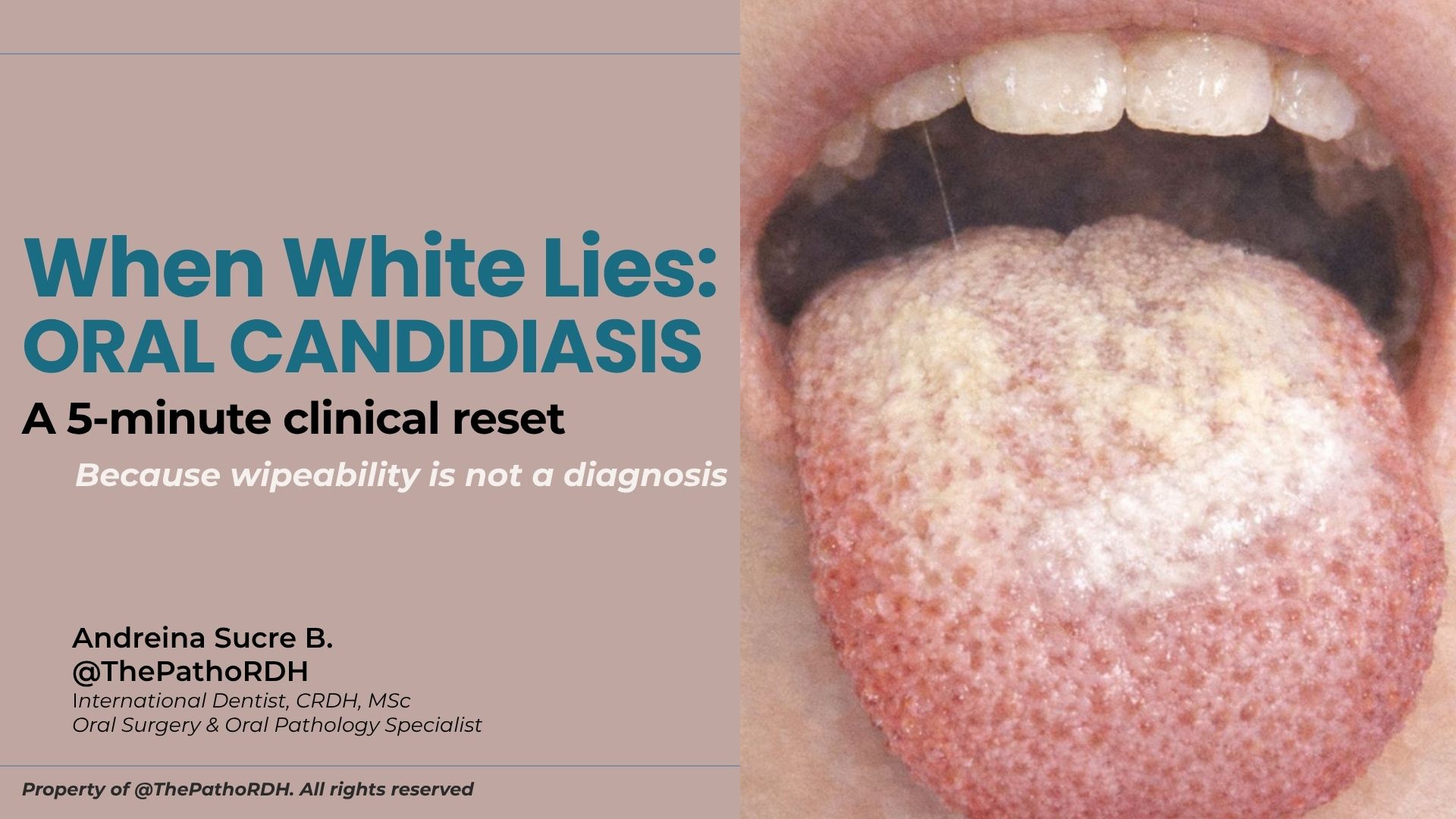 When White Lies: Oral Candidiasis. A Clinical Reset
